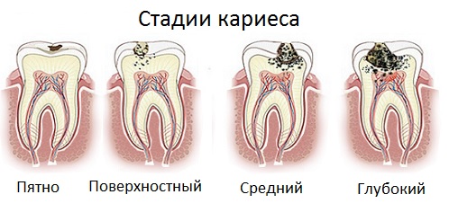 лечение кариеса - стадии кариеса зубов