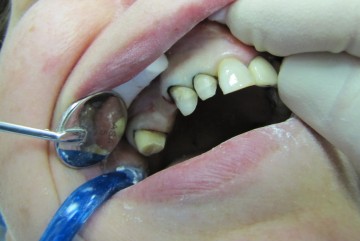 Зубы обработанные под мостовидный протез 